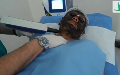 Carbon peel o Hollywood Peel para qué tipo de piel es ideal