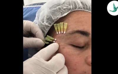 Blefaroplastia en Bogotá resultados naturales y recuperación paso a paso