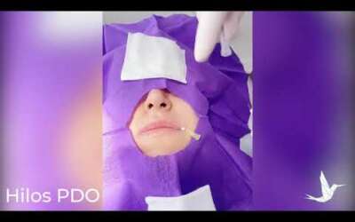 Hilos PDO para papada y cuello resultados antes y después